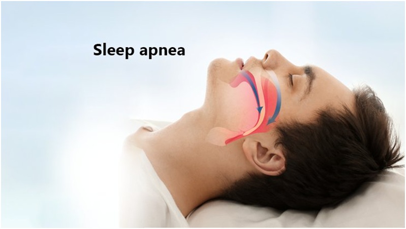The Effects of Weight on Sleep Apnea