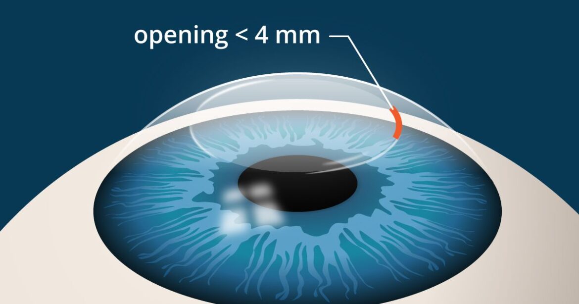 SMILE vs Lasik: Which is the Best Refractive Eye Surgery?