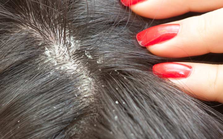  Do you need to know the cause of scalp eczema?