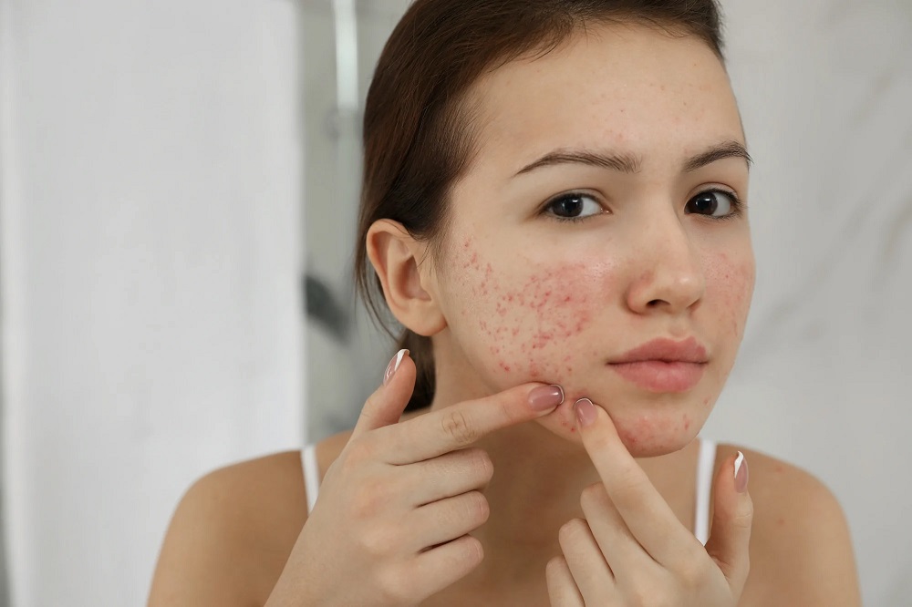 what-are-acne-scars-some-facts-revealed-original-fitness-co