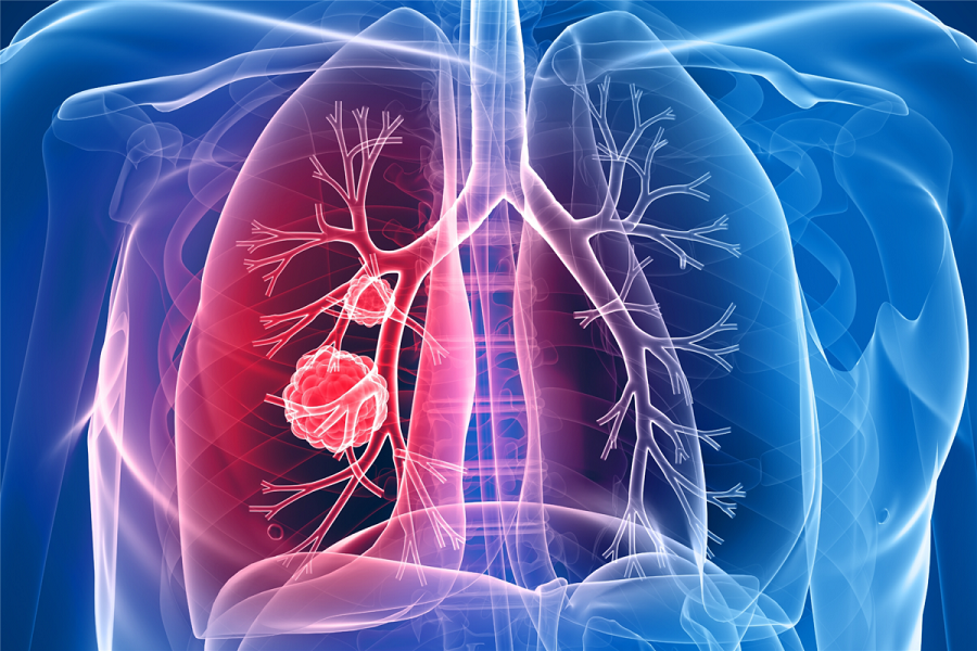  Is lung cancer genetic, and how is it detected?