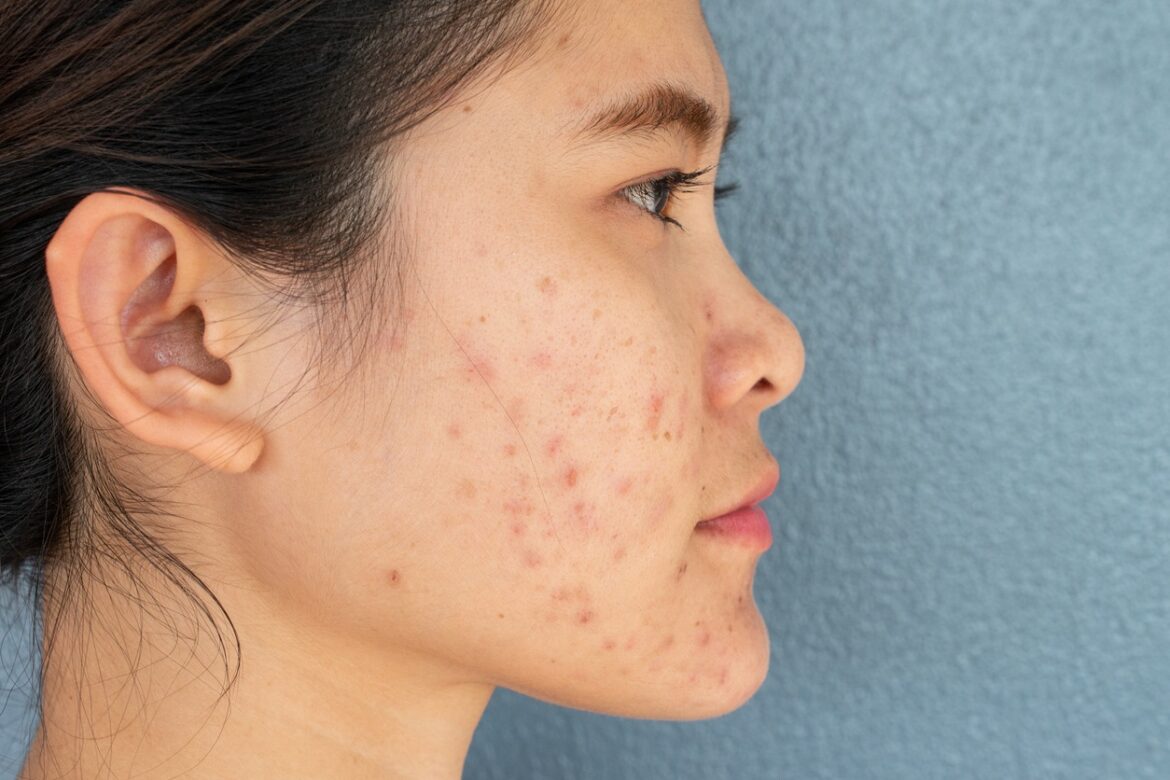 Various Laser Treatments for Acne Scars