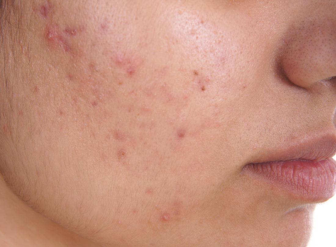 Acne: Causes and Minimally-Invasive Treatments