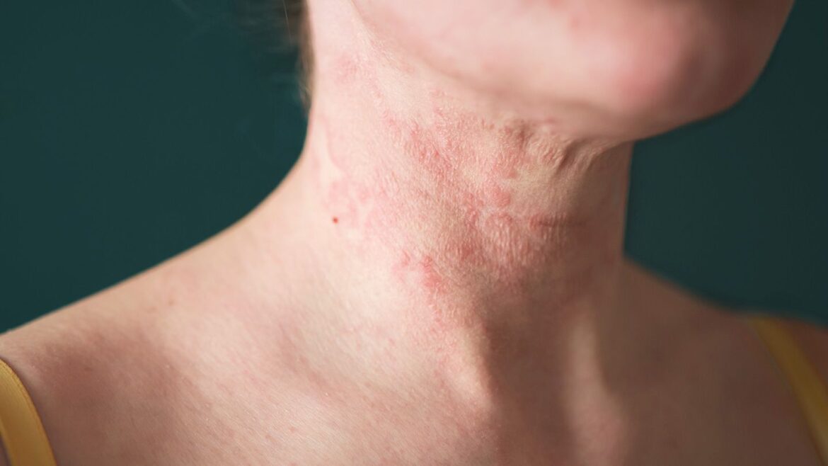 How to Differentiate Eczema and Rashes Based on Their Symptoms