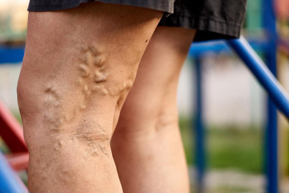 Suffering from Varicose Veins? Here are 5 ways to Overcome