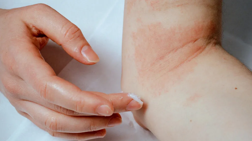 How Does It Feel Like Living With Eczema?