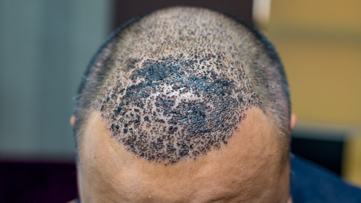 How to Ensure a Successful Hair Transplant Recovery