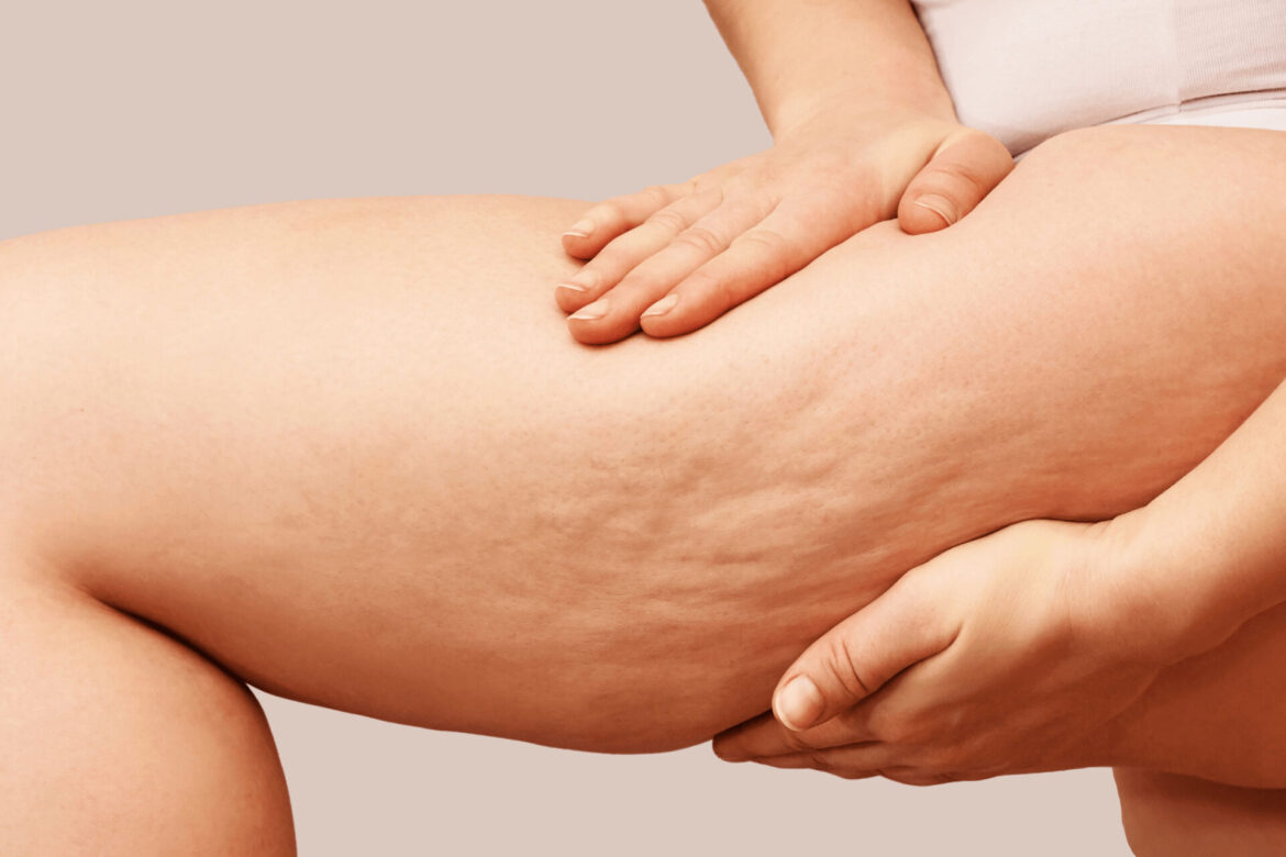 6 Interesting Facts About Cellulite That You Should Understand