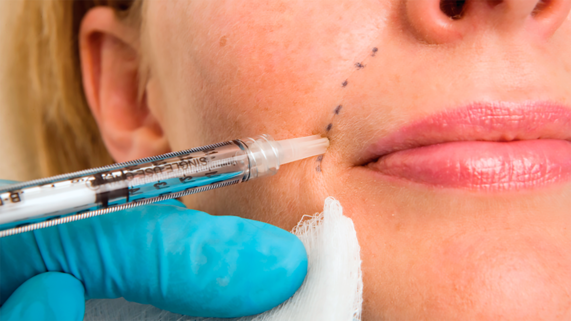 Various Dermal Fillers Options You Can Choose