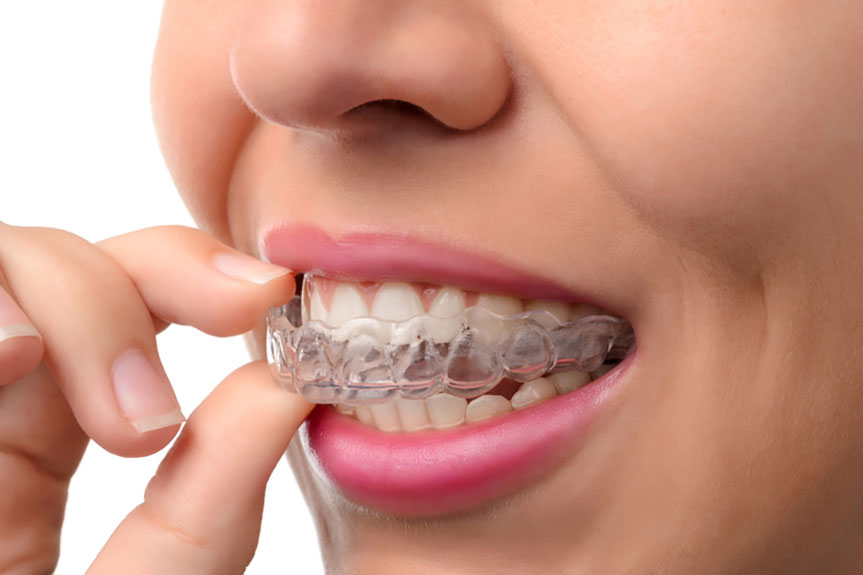 5 Benefits of Invisalign