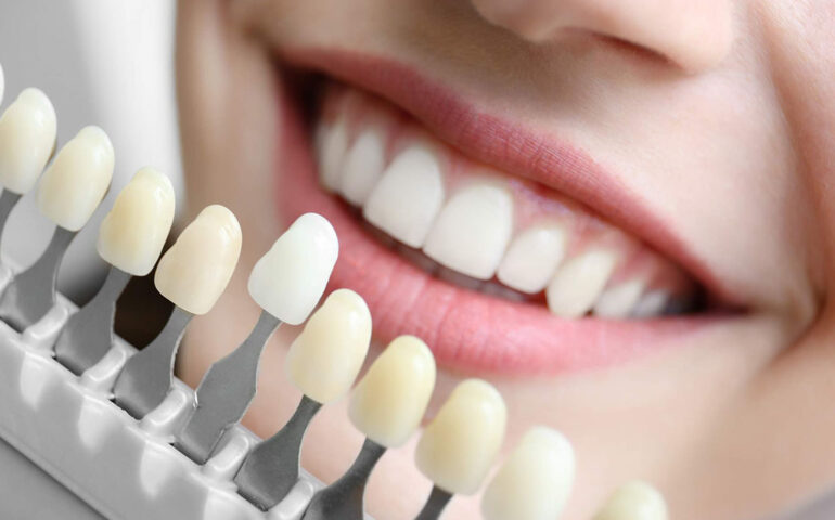 Types of Cosmetic Dentistry