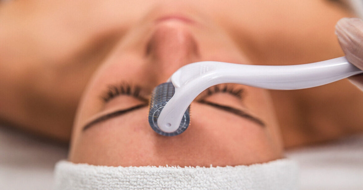 All You Need to Know About Microneedling