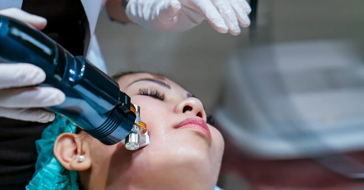 What is RF Microneedling and How Can It Benefit Your Skin?