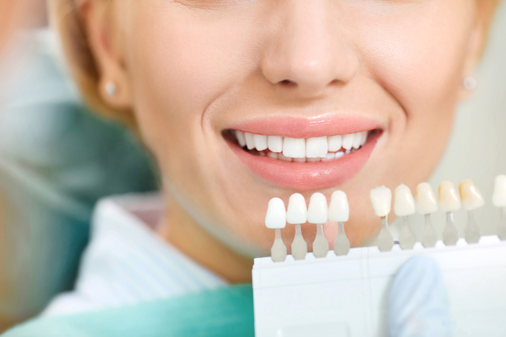 Top 5 Benefits of Professional Teeth Whitening