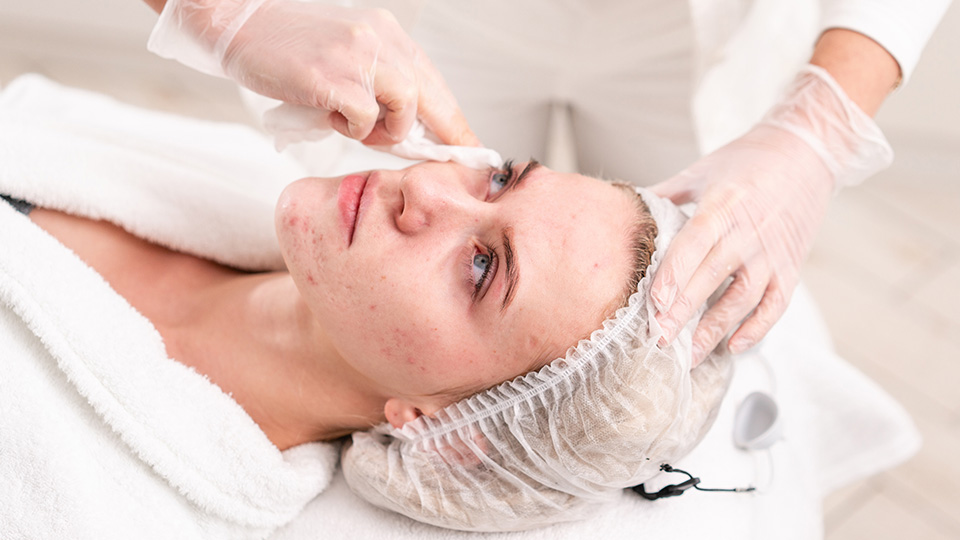 Reasons You Should Consider Acne Facial Treatment