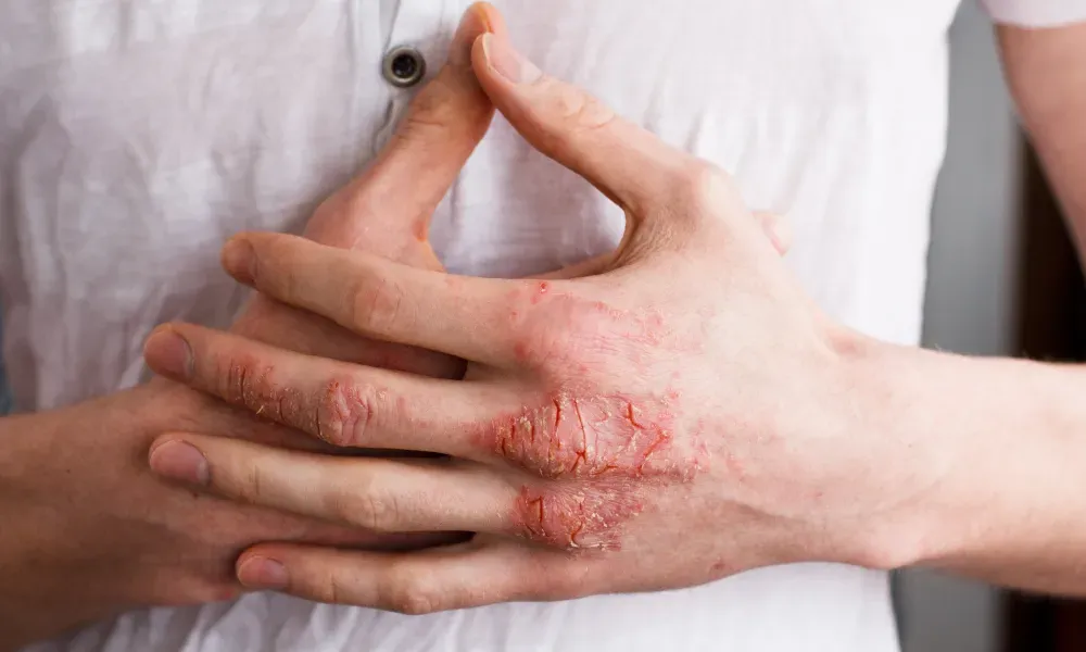 A Few Symptoms of Dermatitis that Can be Treated in Picayune