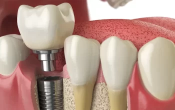 Dental Implants