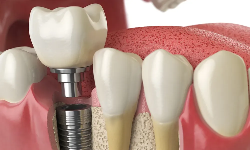 Maritimes-Friendly Dental Implants 