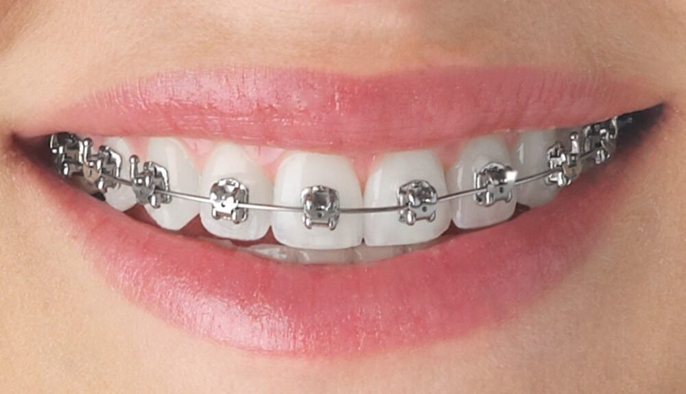 Intervention In Orthodontics