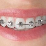 Intervention In Orthodontics