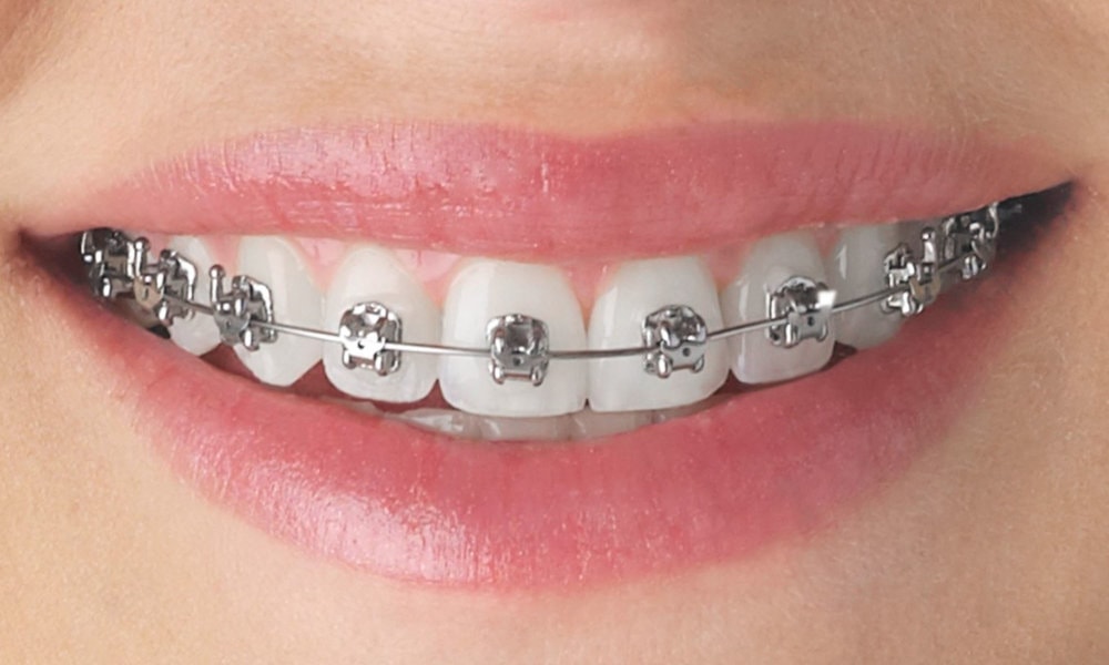 Early Intervention In Orthodontics: Pros And Cons