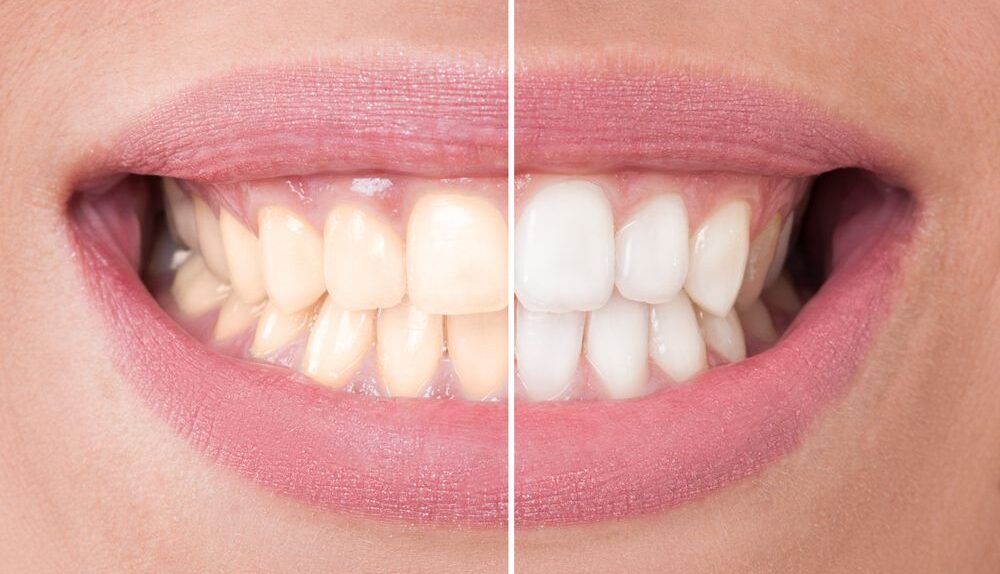 Tooth Whitening