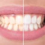 Tooth Whitening