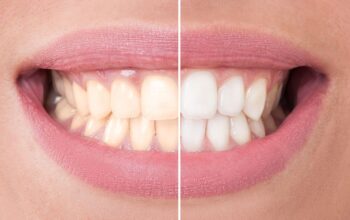 Tooth Whitening