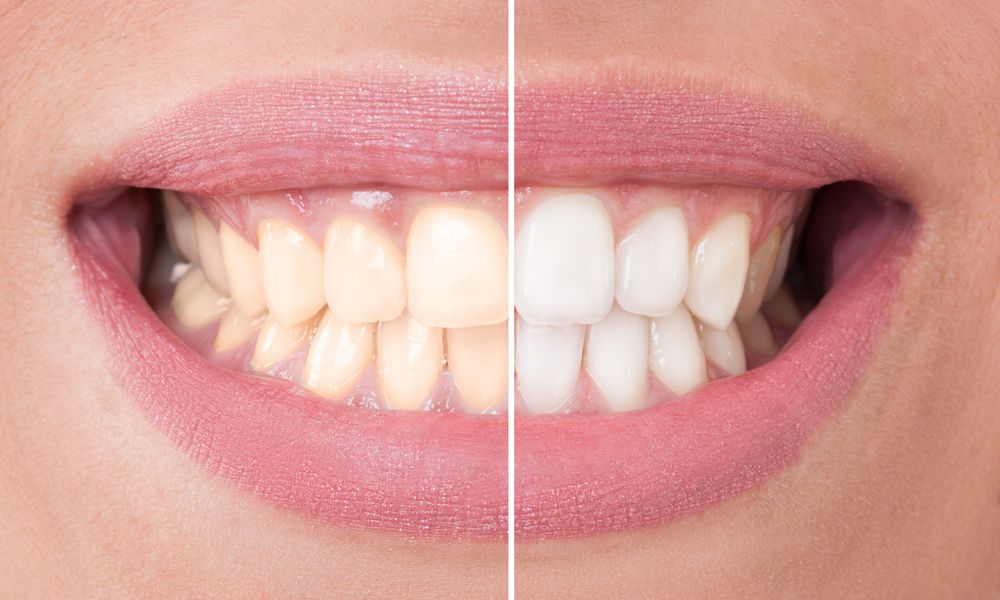 Tooth Whitening Techniques: Professional Insight From A General Dentist