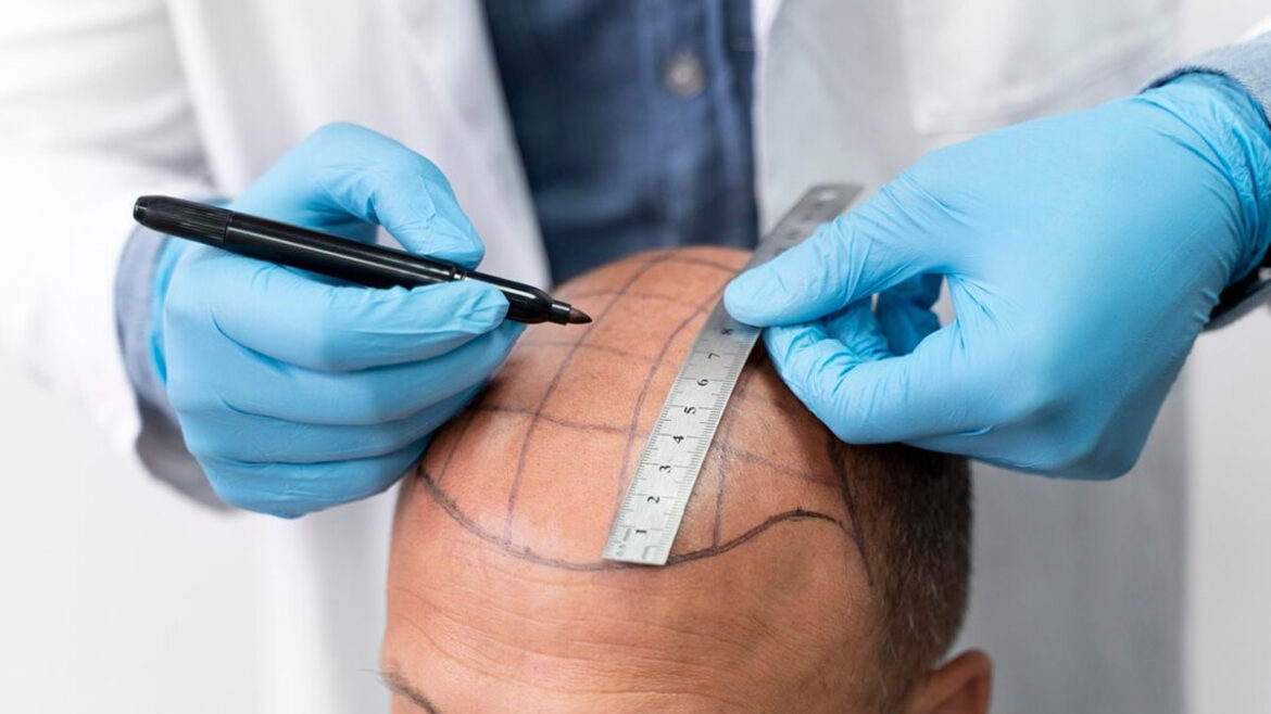 Hair Transplant Procedures: A Dermatologist’s Perspective