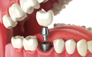 Dental Implants