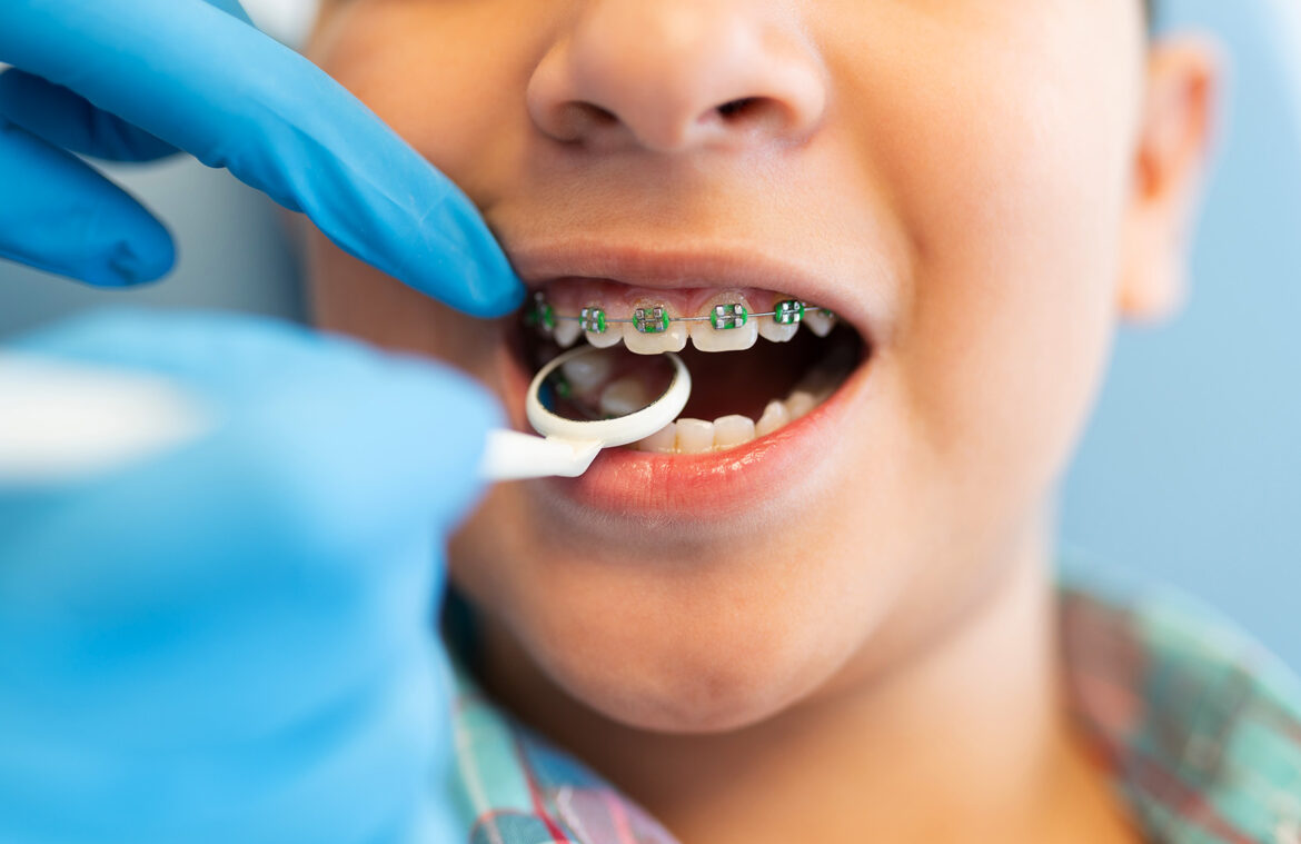 The Benefits Of Early Orthodontic Treatment For Children